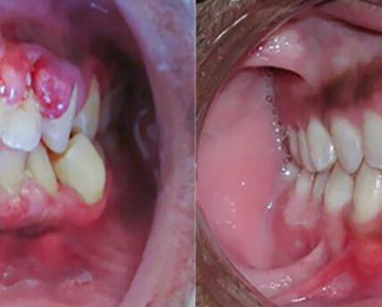 Full Mouth Debridement