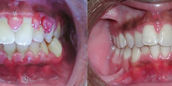 Full Mouth Debridement