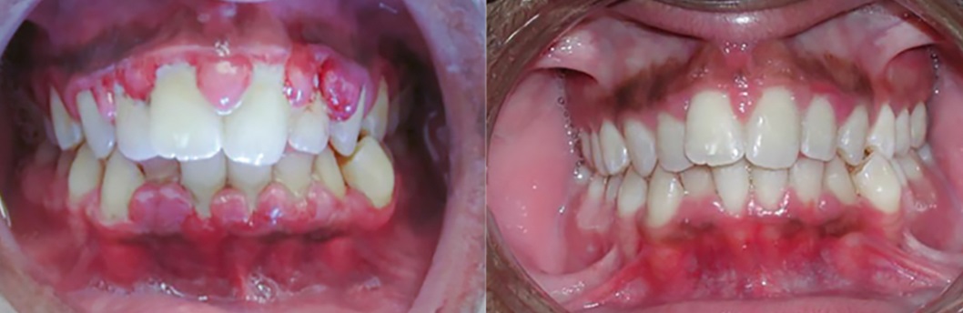 Full Mouth Debridement